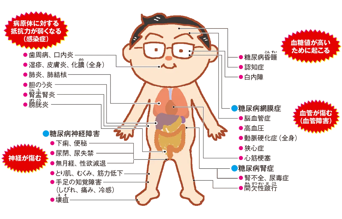 図解：全身に及ぶ糖尿病の合併症