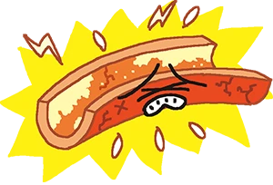 イラスト：動脈硬化